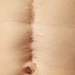 Cicatrices : les bons gestes pour les prévenir.